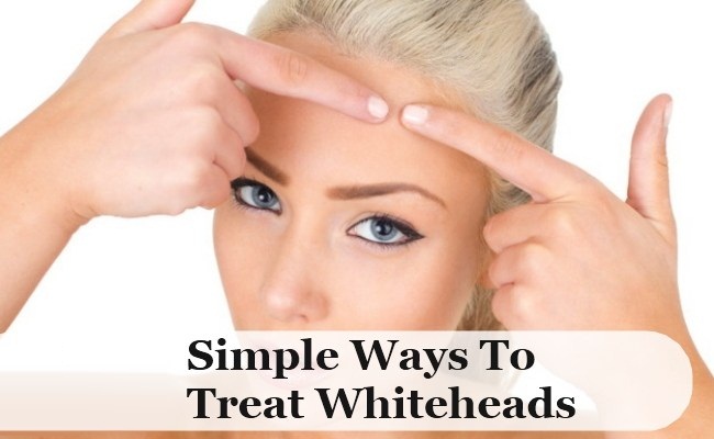 Simple Ways to Get rid of White Heads